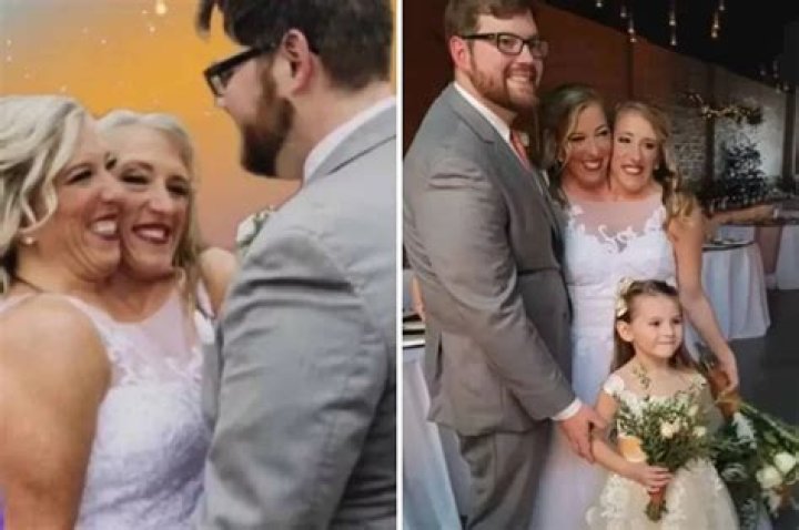 Conjoined Twins Wedding: Celebrating Love Beyond Boundaries