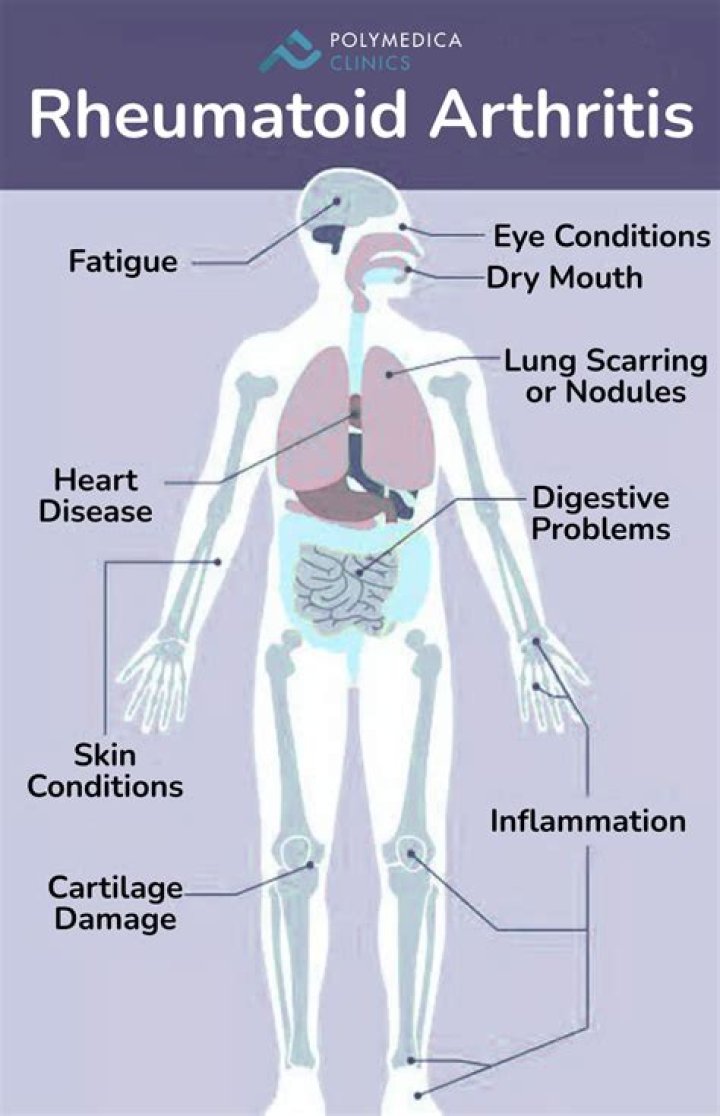 Understanding Rheumatoid Arthritis: What You Should Know About Steve Gerben and This Condition